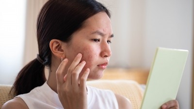 Atrophic scarring improves with adapalene and benzoyl peroxide use © Getty Images